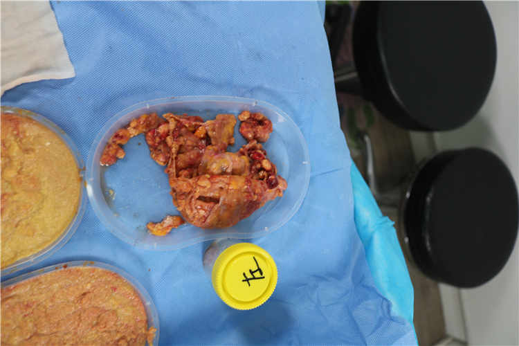 权威医院推荐：奥美定隆胸取出最佳选择